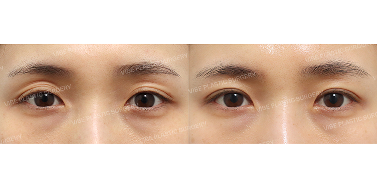 #절개눈매교정 #눈두덩이지방재배치