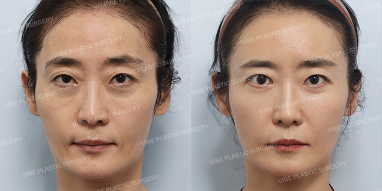 #상안검 #눈매교정 #얼굴지방이식