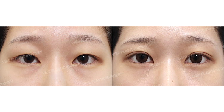 #부분절개쌍꺼풀 #윗트임