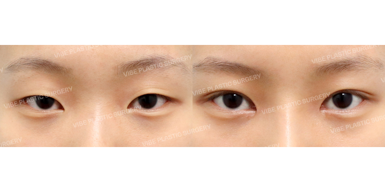 #부분절개눈매교정 #앞트임 #윗트임