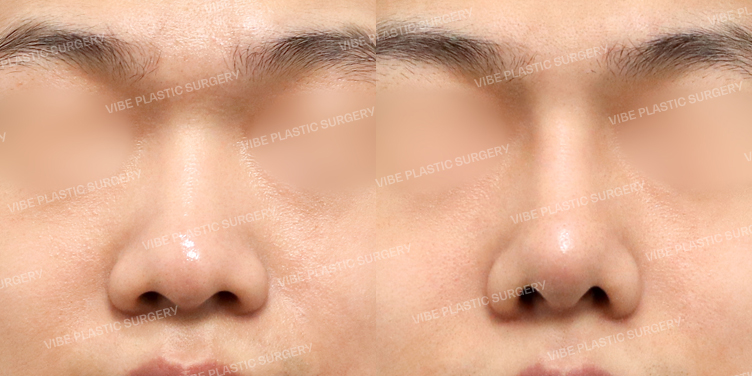 #콧대 #코끝 #절골 #복코 #비순각교정 #기능코