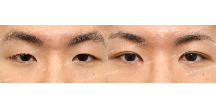 #비절개눈매교정 #앞트임