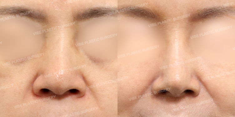 #코재수술 #기증늑 #복코