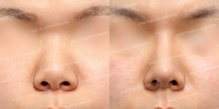 #콧대 #코끝 #기증늑 #복코 #짧은코 #이물질제거