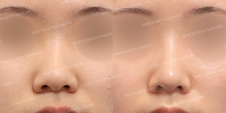 #콧대 #코끝 #기증늑 #비중격