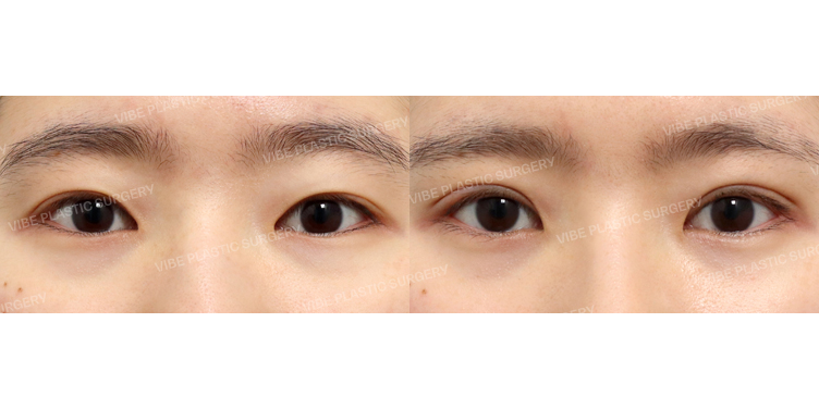 #비절개눈매교정