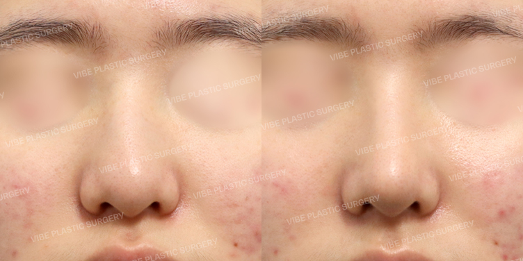 #무보형물코성형 #매부리 #절골 #복코 #긴코 #휜코 #비순각교정