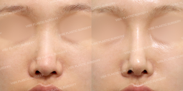 #콧대 #코끝 #기증늑 #절골 #긴코 #비공내리기 #복코 #이물질제거