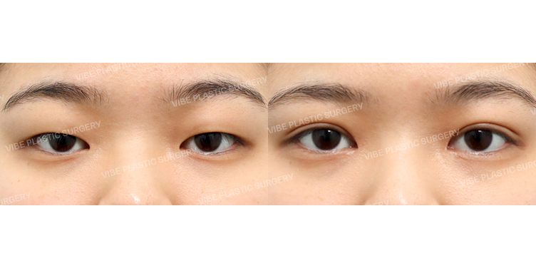 #부분절개눈매교정 #앞트임 #윗트임