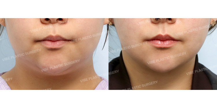 #초음파지방흡입(이중턱, 턱라인) #목거상(이중턱근육묶기) #실리프팅 #사각턱보톡스