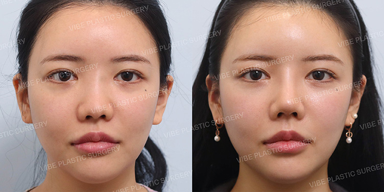 #콧대 #비중격 #기증늑 #복코 #짧은코 #이물질제거