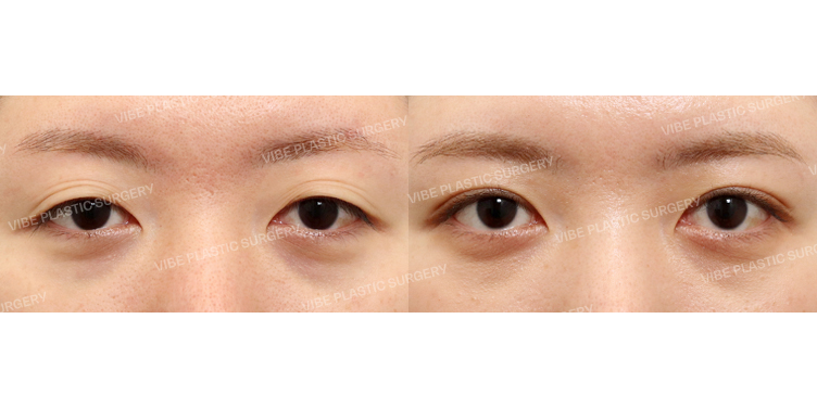 #비절개눈매교정