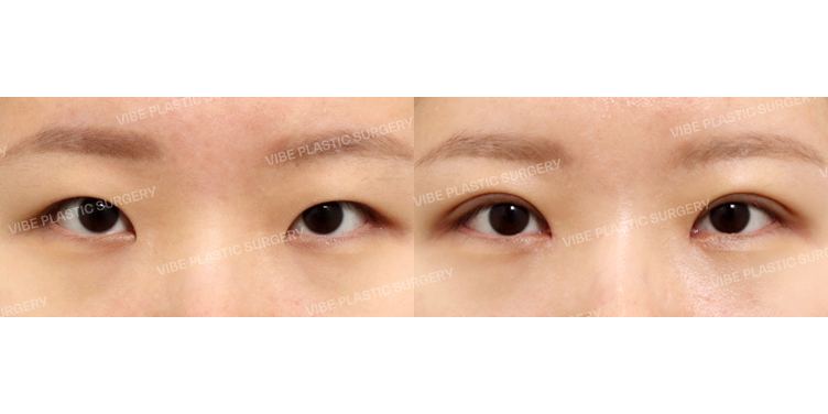 #눈매교정 #앞트임 #윗트임