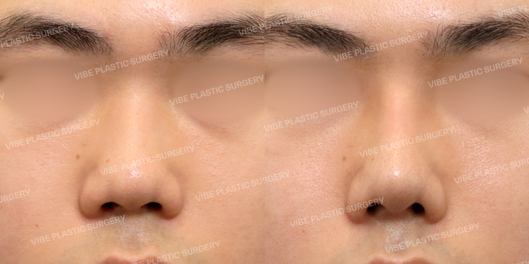 #콧대 #코끝 #비중격 #매부리코 #복코 #기능코