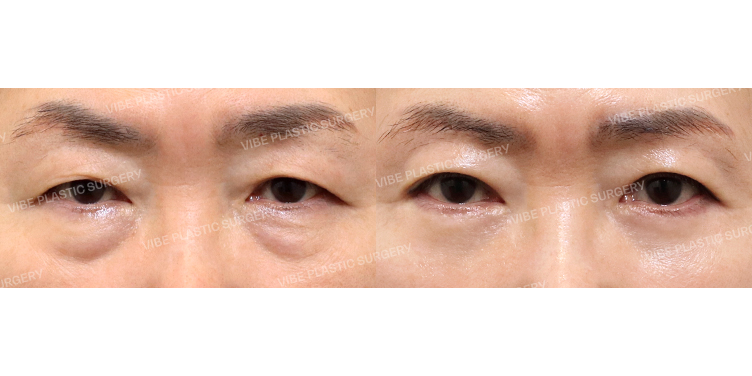 #눈썹밑거상 #부분절개쌍꺼풀 #하안검