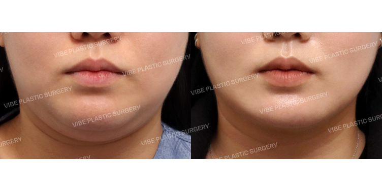 #초음파지방흡입(이중턱,턱라인) #슈링크 #사각턱보톡스