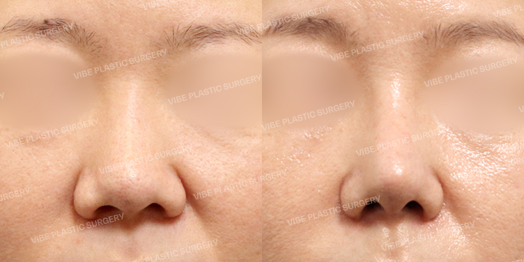 #콧대 #코끝 #비중격 #기증늑 #복코 #비순각교정 #이물질제거 #콧볼축소