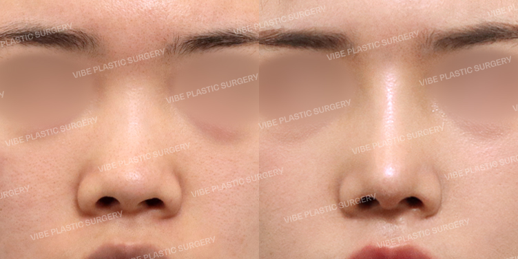 #콧대 #코끝 #절골 #복코 #짧은코 #비중격