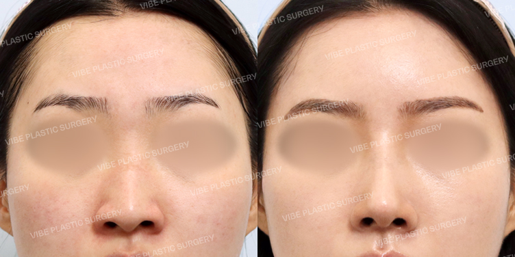 #지방이식(이마,관자) #콧대 #코끝 #절골 #휜코 #긴코 #이물질제거 #비중격 #기증늑