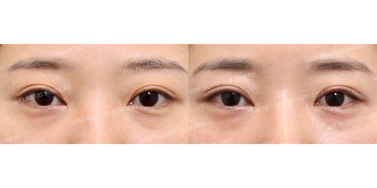 #절개눈매교정(재수술)