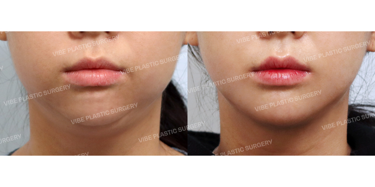 #초음파지방흡입(이중턱,턱라인,팔자위,앞볼) #목거상(이중턱근육묶기)