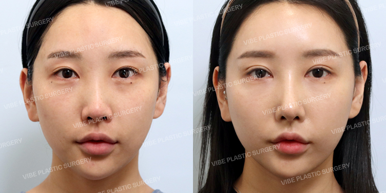 #콧대 #코끝 #자가늑 #이물질제거 #비순각교정 #휜코 #절골 #기능코