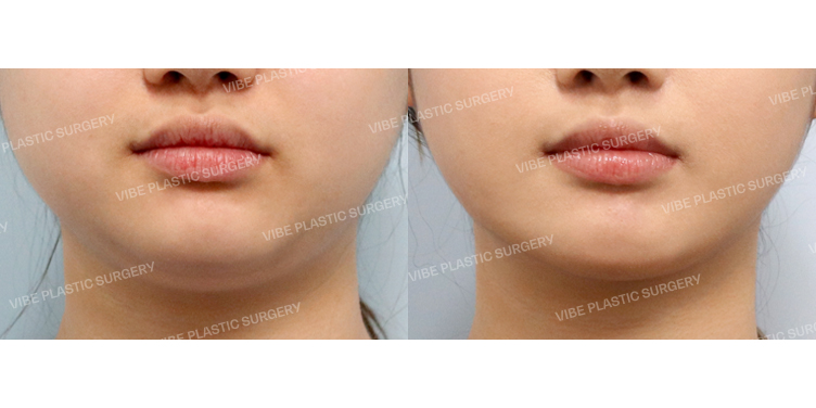 #초음파지방흡입(이중턱,턱라인) #슈링크