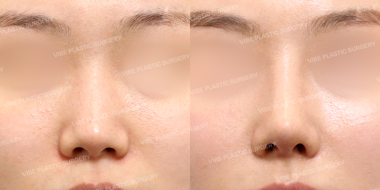 #콧대 #코끝 #매부리코 #짧은코 #비순각교정 #비중격 #기증늑