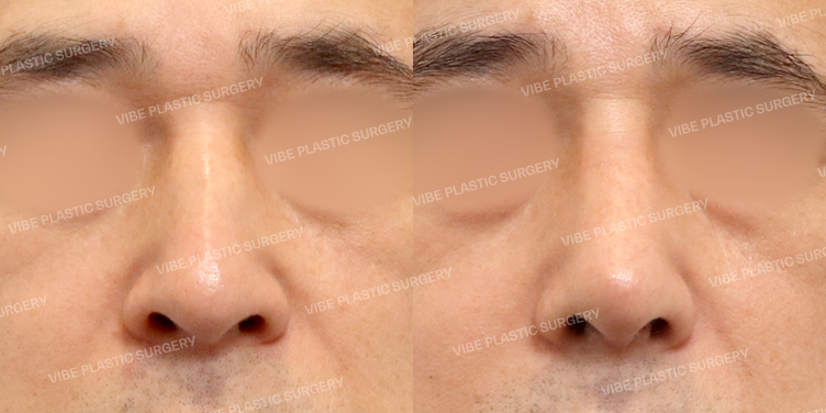 #코끝 #무보형물 #매부리코 #절골 #긴코 #휜코 #비중격