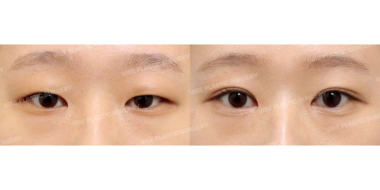 #부분절개눈매교정 #윗트임 #앞트임