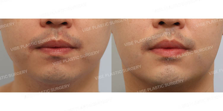 #이중턱지방흡입 #심부볼지방제거 #턱끝필러 #턱보톡스
