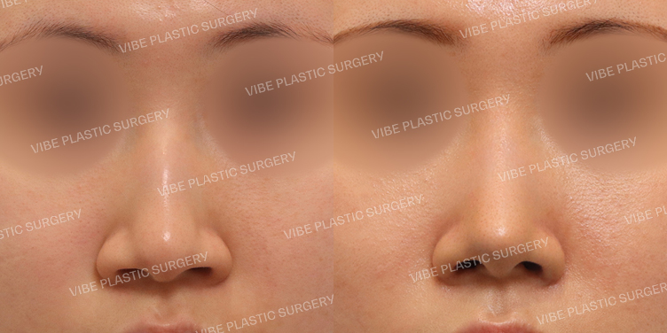 #무보형물 #매부리코 #콧볼축소