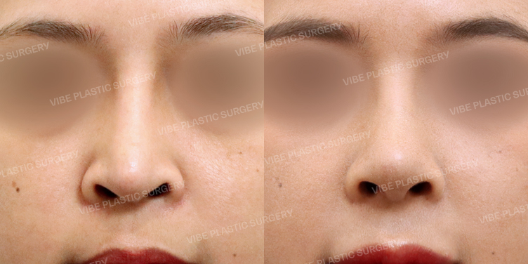 #눌린코끝교정 #비공내리기 #보형물낮추기