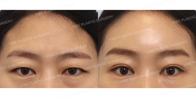 #부분절개눈매교정 #내시경이마거상