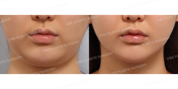 #초음파지방흡입(이중턱,턱라인)