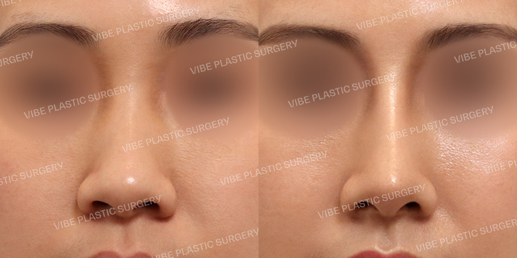 #매부리코 #복코