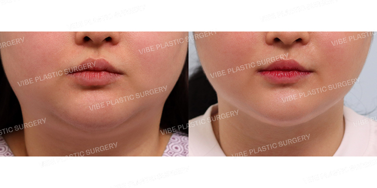 #초음파지방흡입(이중턱,턱라인)