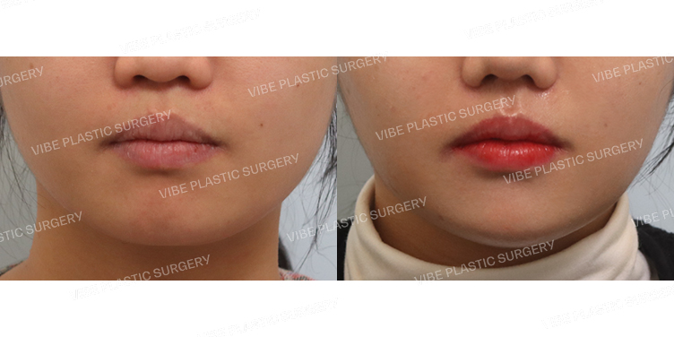 #심부볼지방제거 #이중턱&턱라인(초음파지방흡입)