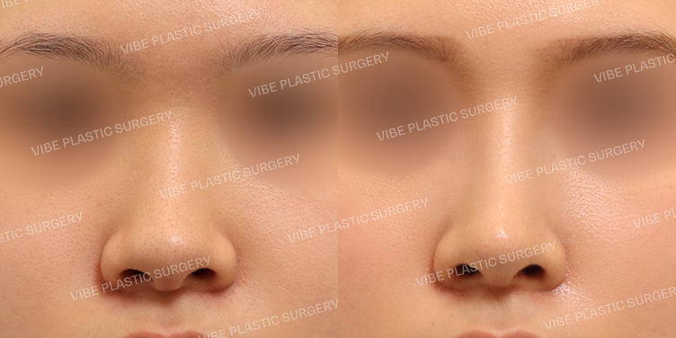 #복코 #매부리코