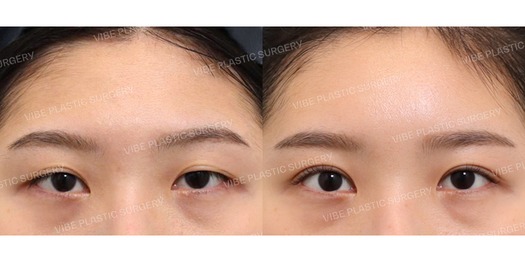 #절개눈매교정(재수술) #이마지방이식