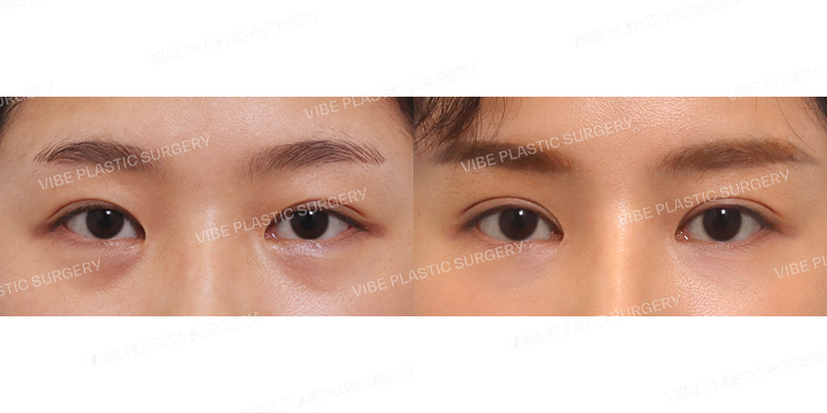 #절개눈매교정(재수술) #앞트임 #눈밑지방재배치