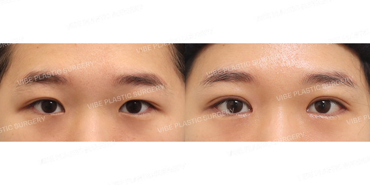 #부분절개눈매교정 #앞트임 #뒤트임 #밑트임