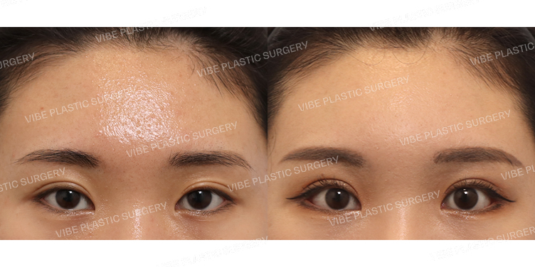 #내시경이마거상 #비절개눈매교정 #뒤트임 #밑트임