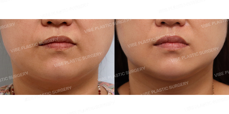 #초음파지방흡입(이중턱,턱라인)