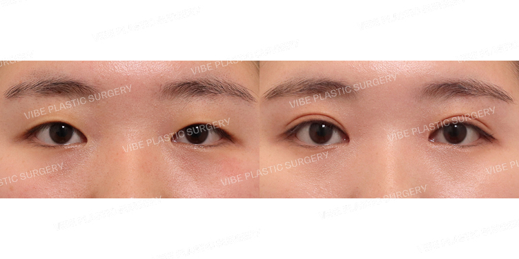 #절개쌍꺼풀 #앞트임