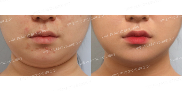 #초음파지방흡입(이중턱,턱라인)