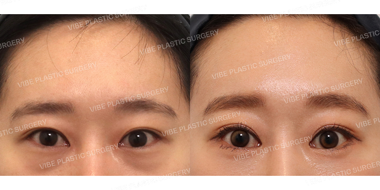 #하안검 #내시경이마거상