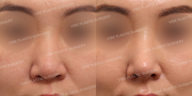 #무보형물 #매부리코 #복코 #긴코