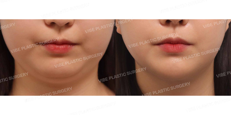 #초음파지방흡입(이중턱,턱라인)