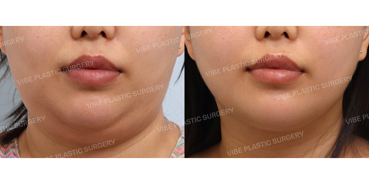 #초음파지방흡입(이중턱,턱라인)